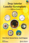 Deep Anterior Lamellar Keratoplasty Different Strokes